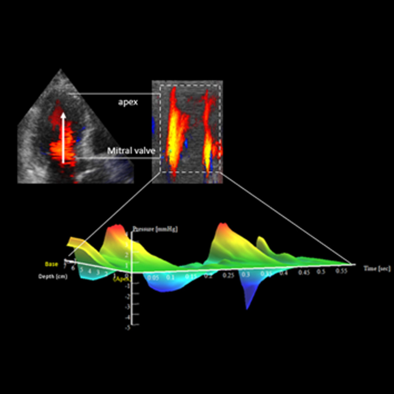 Visualize and quantify intraventricular pressure differences