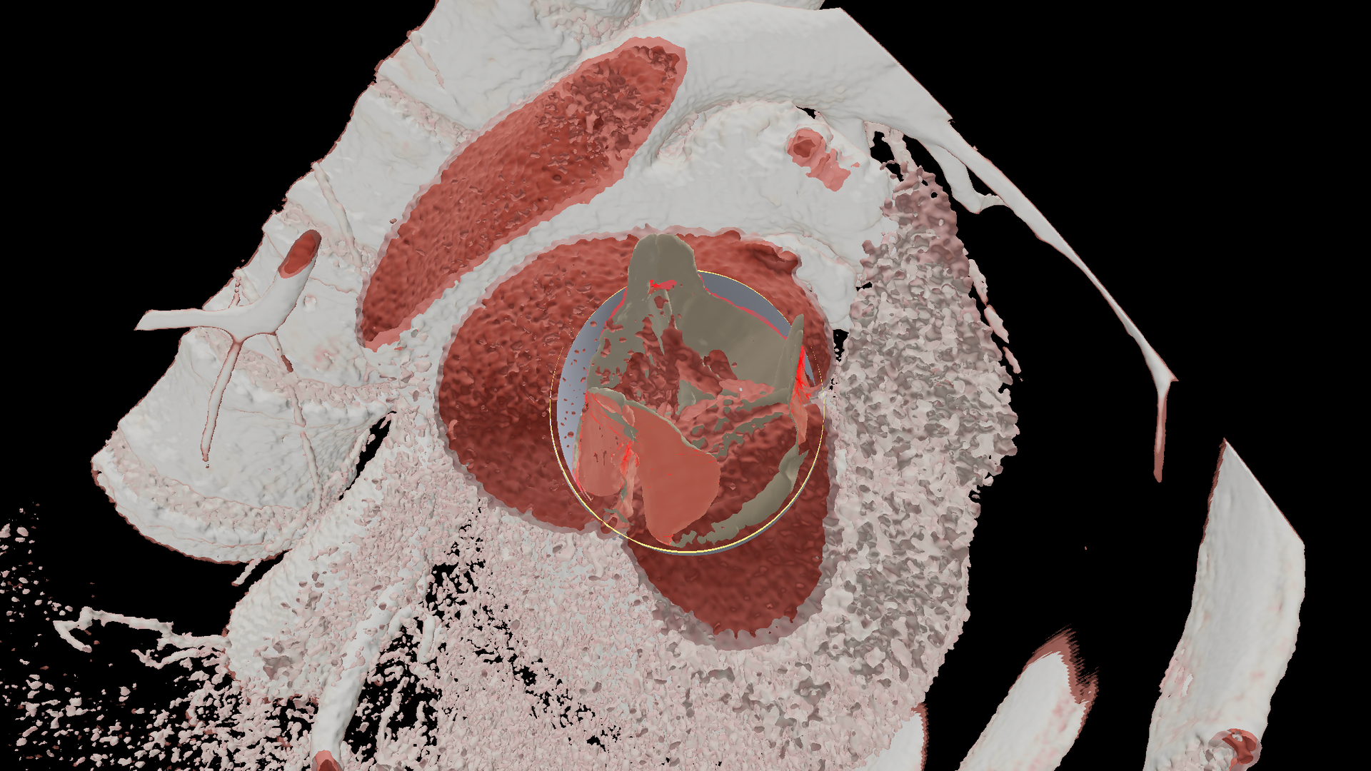 CT Overlay with Graft